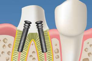 Endodoncia